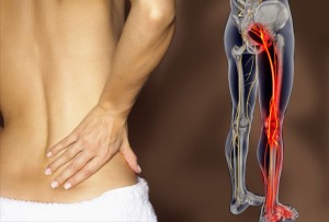 Sciatica Symptoms Including Back Pain and Leg Cramps