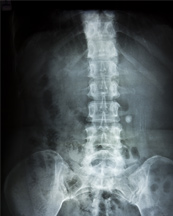 What are some symptoms of degenerative disc disease in the thoracic spine?